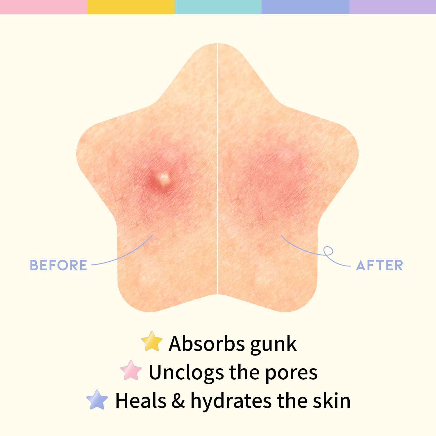 OOTD - HYDROCOLLOID BLEMISH CARE STAR SPOT PATCH