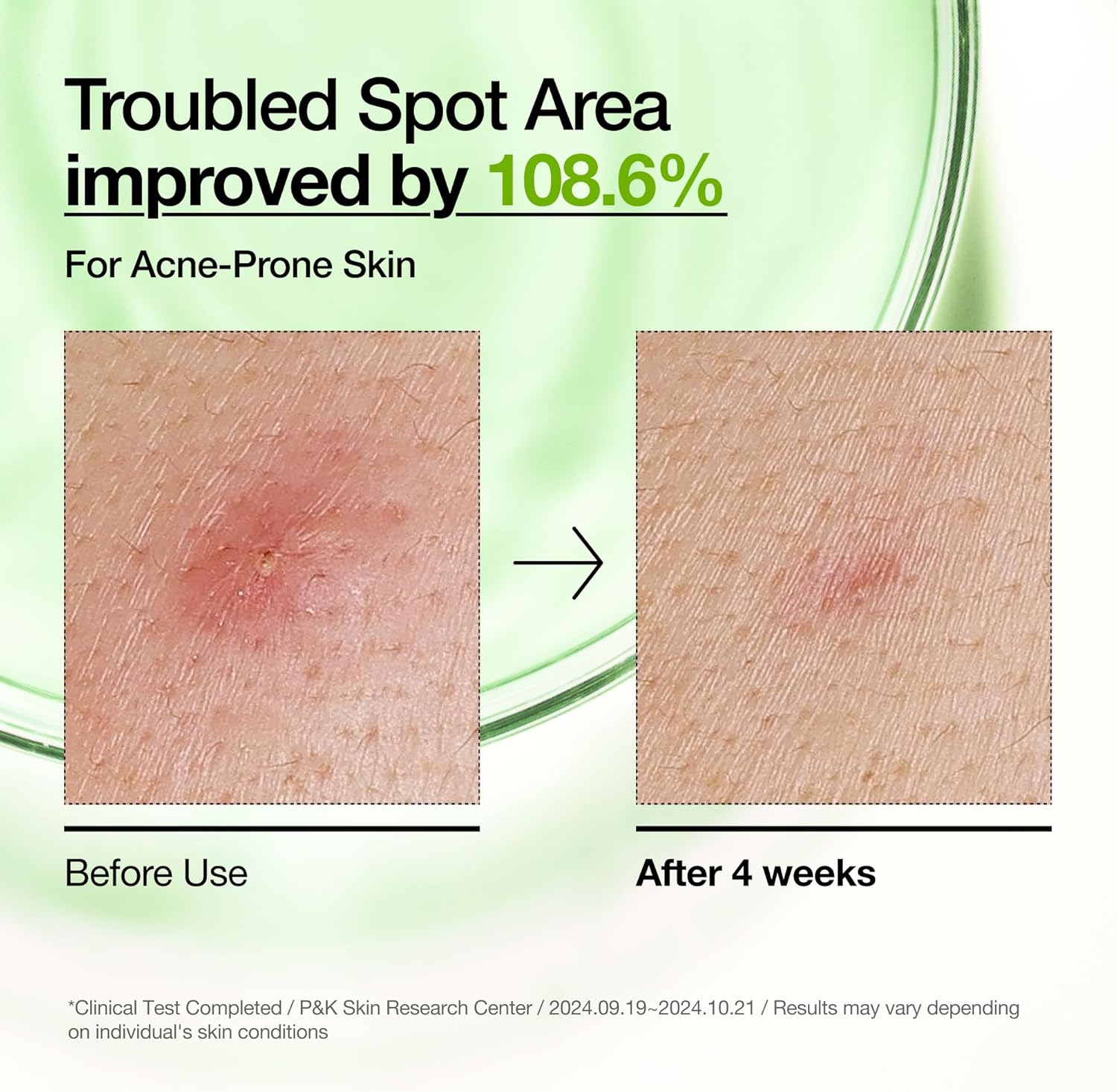 ANUA - AZELAIC ACID 10 HYALURON REDNESS SOOTHING SERUM 30ml