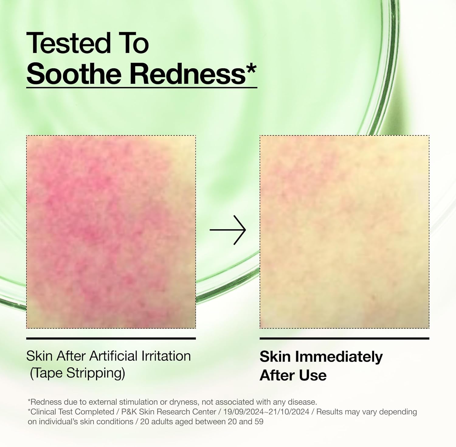 ANUA - AZELAIC ACID 10 HYALURON REDNESS SOOTHING SERUM 30ml